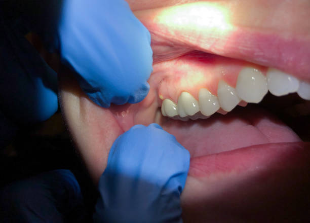 Best Emergency Dentist for Lost Fillings or Crowns in Kiln, MS
